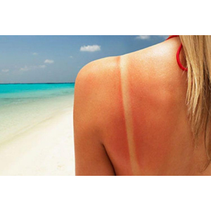 Spray 'coup de soleil '